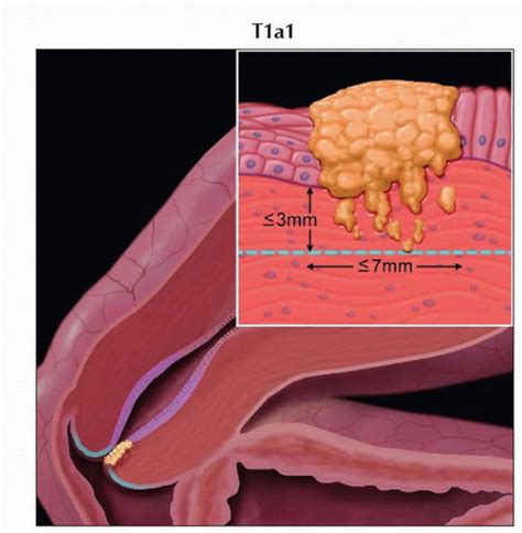 Cervix Uteri Carcinoma Radiology Key