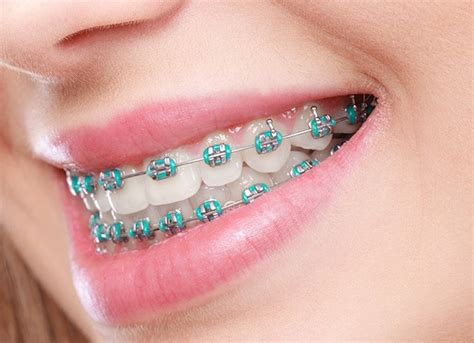 Orthodontics Parsippany Nj Invisalign Traditional Braces