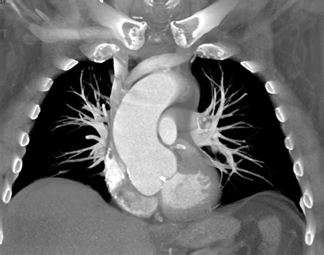 Calcified Bicuspid Aortic Valve With Dilated Ascending Aorta Cardiac