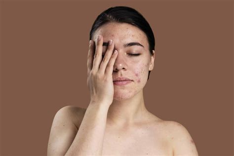 Can Dry Skin Cause Acne Healthxtips