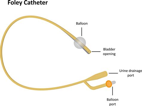 Induction Methods Balloon Catheter Back To Basics Birthing