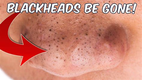 Get Rid Of Blackheads Naturally Fast And Easy At Home Youtube