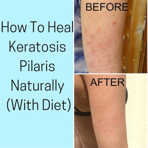 How To Heal Keratosis Pilaris With Diet Pure And Simple Nourishment