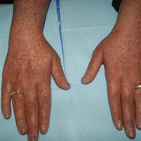 Reticulate Hyperpigmented And Hypopigmented Macules On Dorsa Of Hands