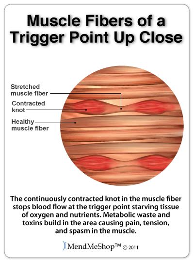 Trigger Points Of The Knee