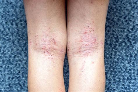 6 Tipos De Eczema Eccema Qué Es Síntomas Y Tratamiento Mdsaúde