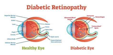 Diabetic Retinopathy Symptoms Treatment Prevention