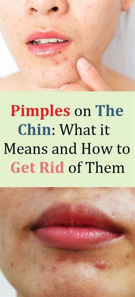 Pimples On The Chin What It Means And How To Get Rid Of Them In 2020