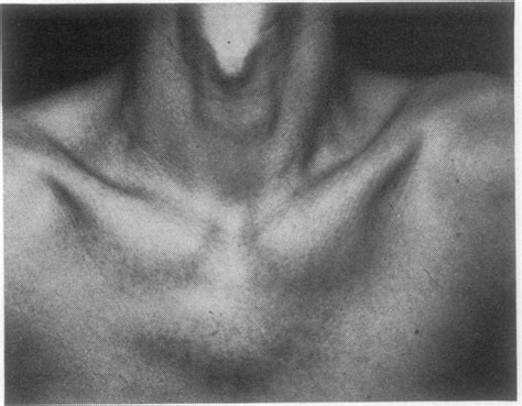 Anteriorchest Wall Symptoms Swelling At The Bilateral Costoclavicular