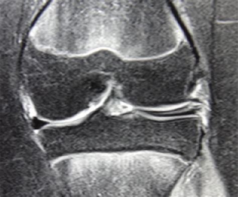 Coronal Slice Of Mri Showing Discoid Lateral Meniscus With Complex My Xxx Hot Girl