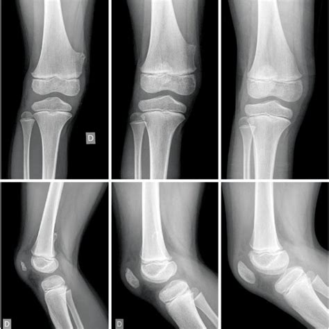 Anteroposterior And Lateral X Rays Of The Left Knee A 10 Year Old Boy