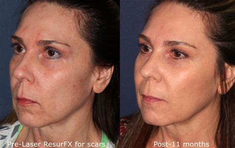 Acne Body And Facial Scar Treatment By San Diego Specialists