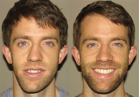 Corrective Jaw Surgery Photo Patient 6 Guyette Facial And Oral Surgery