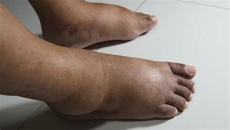 Feet People Diabetes Dull Swollen Due Stock Footage Video 100 Royalty