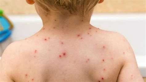 Monkeypox Signs And Symptoms In Kids To Watch Out For Health