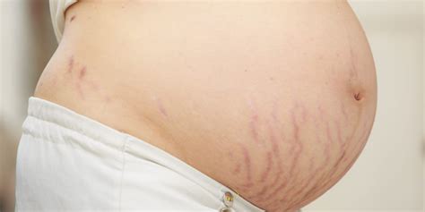 Troubled With Stretch Marks After Giving Birth How Microneedling Helps Reduce Stretch Marks Or