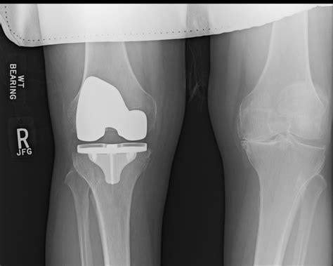 Ortho Dx Pain And Swelling Following Knee Replacement Clinical Advisor