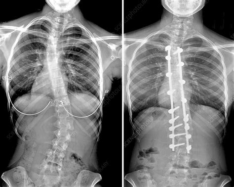 Scoliosis Before And After Surgery X Ray Stock Image C043 5959 Science Photo Library