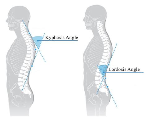 The Angles Of The Kyphosis And Lower Back Lordosis 30 Download