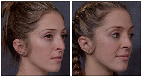 May 17, 2018 · kim revealed in the stylish magazine that her perfect nose isn't because of a nose job. How Much Does a Nose Job Cost? | Dr Hodgkinson