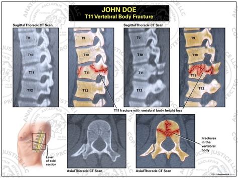 Types Of Compression Fractures Radiology Design Talk