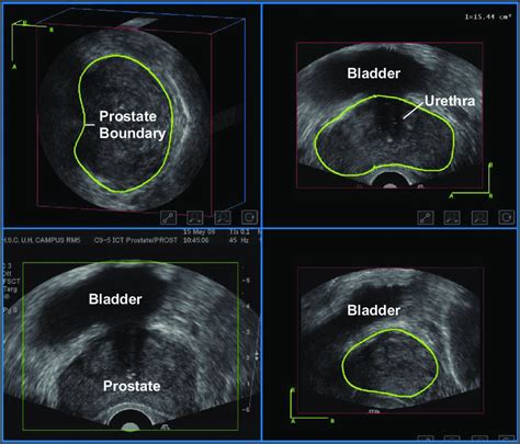 Axial Top Left Sagittal Top Right And Coronal Views Bottom Right Of