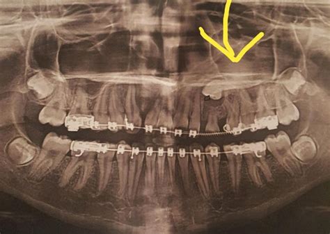 Orthodontics Is So Amazing That A 13 Year Old With A Tooth Growing In