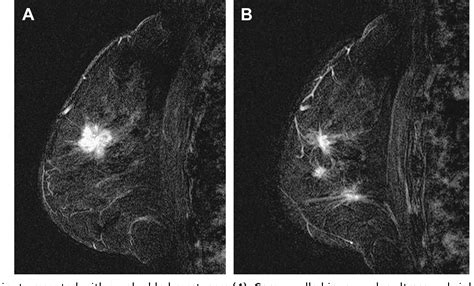 Figure 6 From Evolving Role Of Mri In Breast Cancer Imaging Semantic