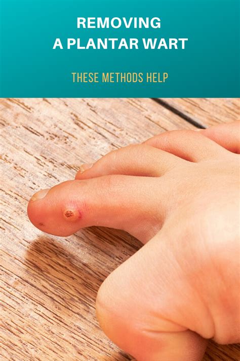 Removing A Plantar Wart These Methods Help Warts Remedy Warts Foot Warts