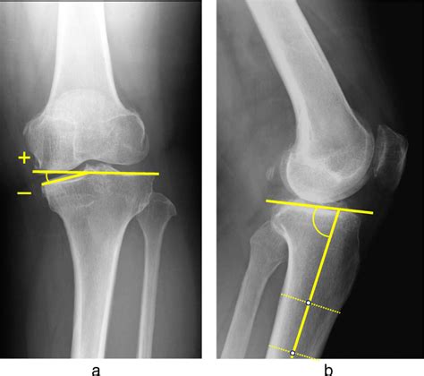 A Medial Tibial Plateau Depression Mtpd And B Posterior Proximal