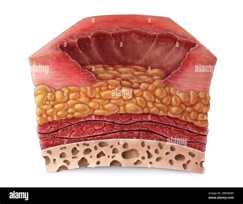 3rd Degree Burn Hi Res Stock Photography And Images Alamy