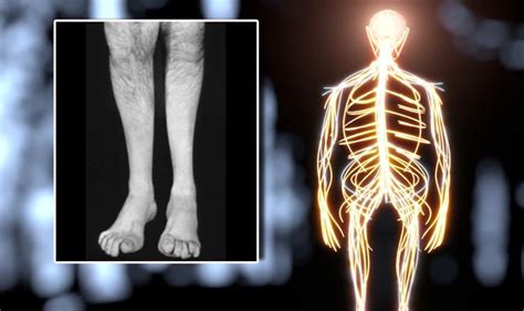 It occurs when there are mutations in the genes that affect the nerves in your feet, legs, hands and arms. Charcot-Marie-Tooth: Painful progressive neurological ...