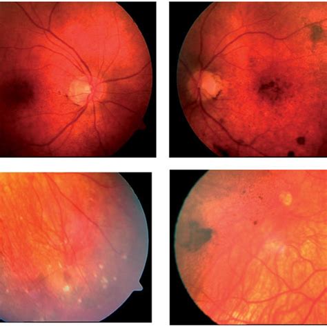 A Vkh Patient Presenting At The Chronic Stage With Sunset Glow Fundus