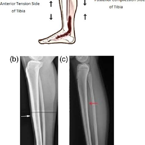 A Return Rates For Anterior Tibial Diaphyseal Stress Fractures B