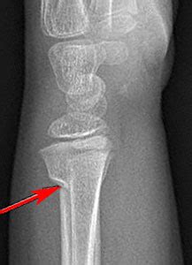 Clinical Practice Guidelines : Distal radius and or ulna ...
