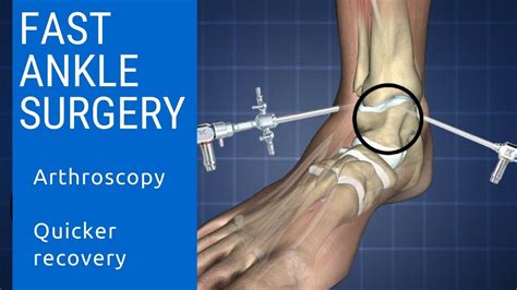 What Is Fast Ankle Surgery Ankle Arthroscopy Youtube