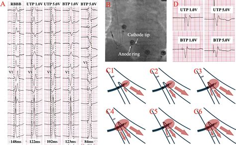 Frontiers The Physiologic Mechanisms Of Paced QRS Narrowing During Left Bundle Branch Pacing