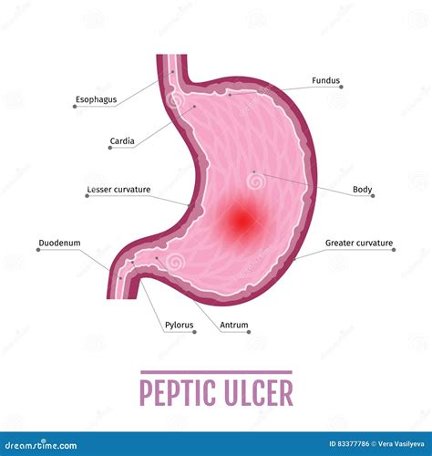Illustrazione Medica Dello Stomaco Umano Con L Ulcera Peptica Schema
