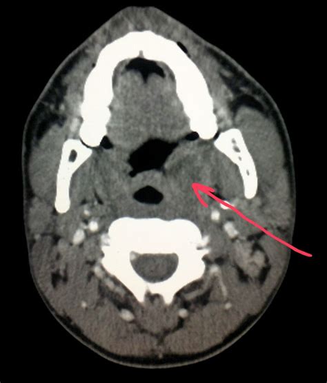 Neck Ct In A Patient With A Sore Throat And Difficulty Swallowing