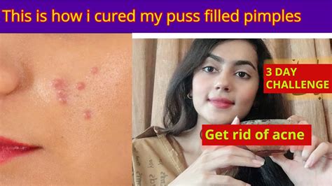 Home Remedy To Cure Puss Filled Pimples Get Rid Of Acne Get Rid Of