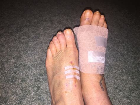 Before During And After Bunion Surgery First Two Weeks After