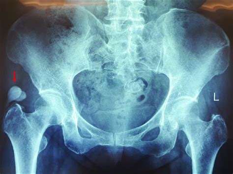 Pelvic Anteroposterior Ap Radiograph Showing Calcification Over The