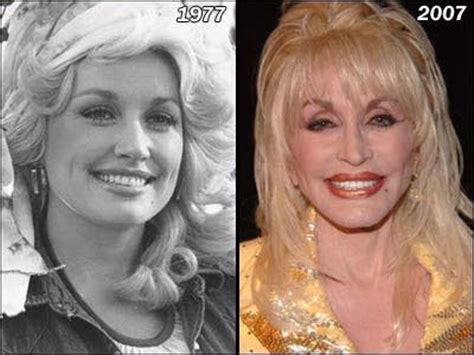 Dolly Parton Plastic Surgery Before and After Photos ...