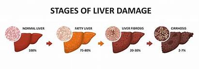Liver Disease Fibrosis Cirrhosis Chronic Stages Damage