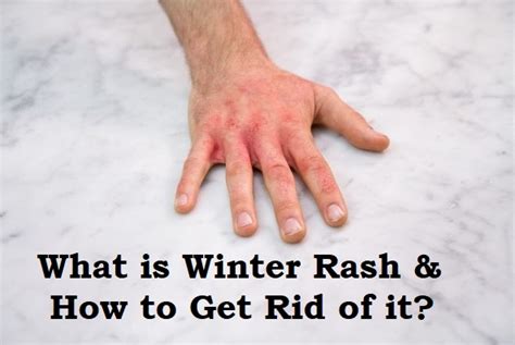 What Is Winter Rash And How To Get Rid Of It Magnificent Post