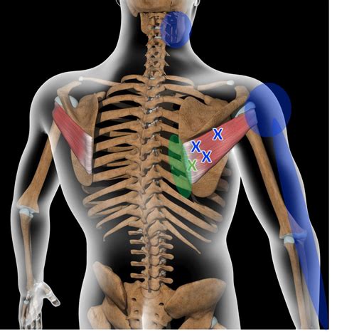 Teres Major Muscle Pain