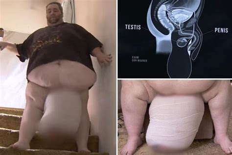 The Man With 5st Scrotum That Wouldnt Stop Growing