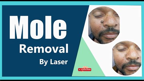 Mole Removal By Laser Dr Sanjeeb Rout Balaji Superspecialty