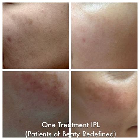 Do You Know About The Iplphotofacial You Can Reduce