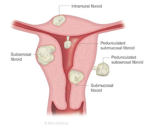 Questions To Ask A Fibroid Specialist New York City 1 Fibroid Center